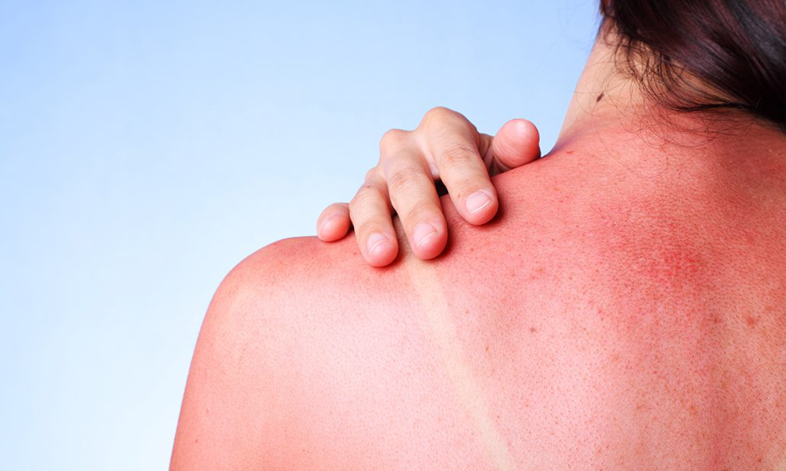 How to Heal Sunburn: Tips for Treatment and Prevention