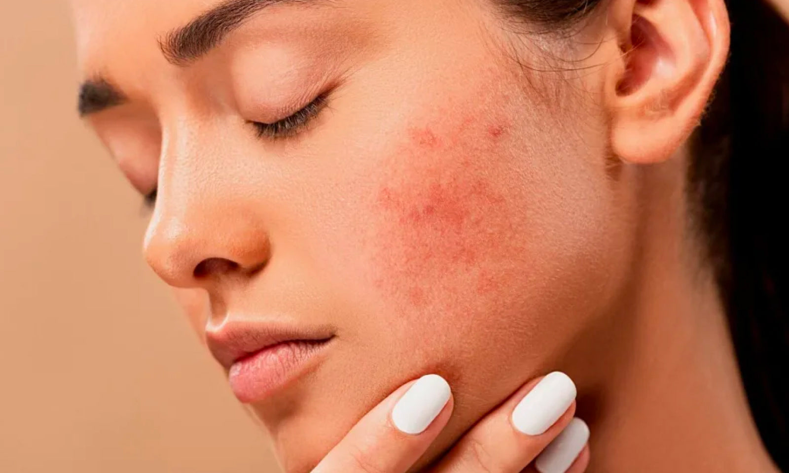 Acne During Your Period? Causes and What You Can Do