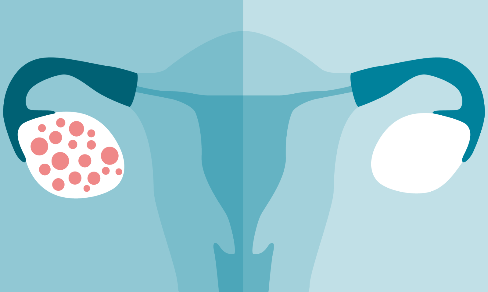 What Is Polycystic Ovary Syndrome (PCOS)?